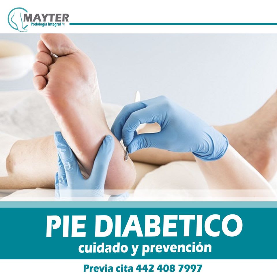 Atencion a pie diabético Servicios de podologia Podología Integral