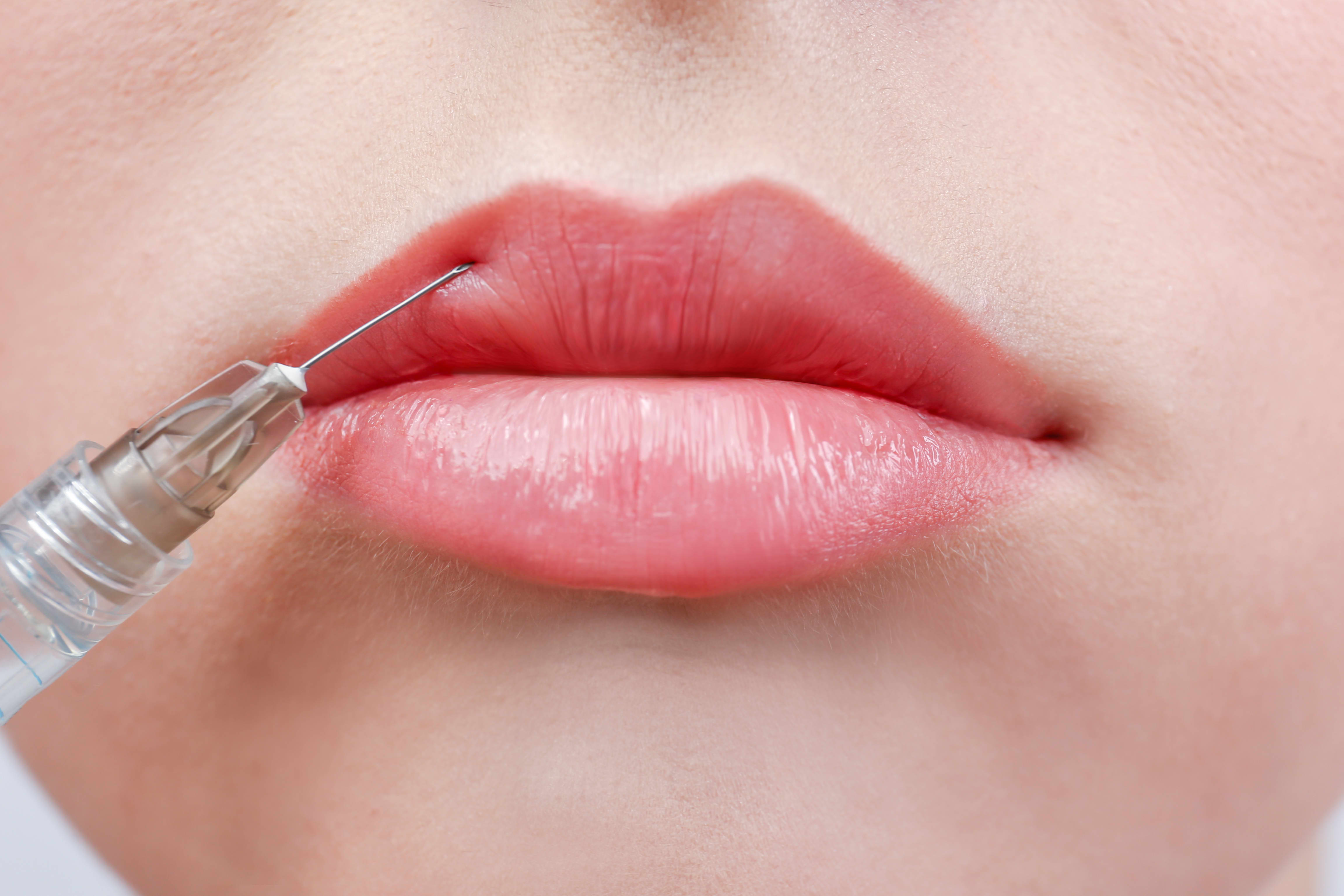 0.5ml Russian Lips - Lip Fillers - Beauty and the Needle | Beautician in  Birmingham