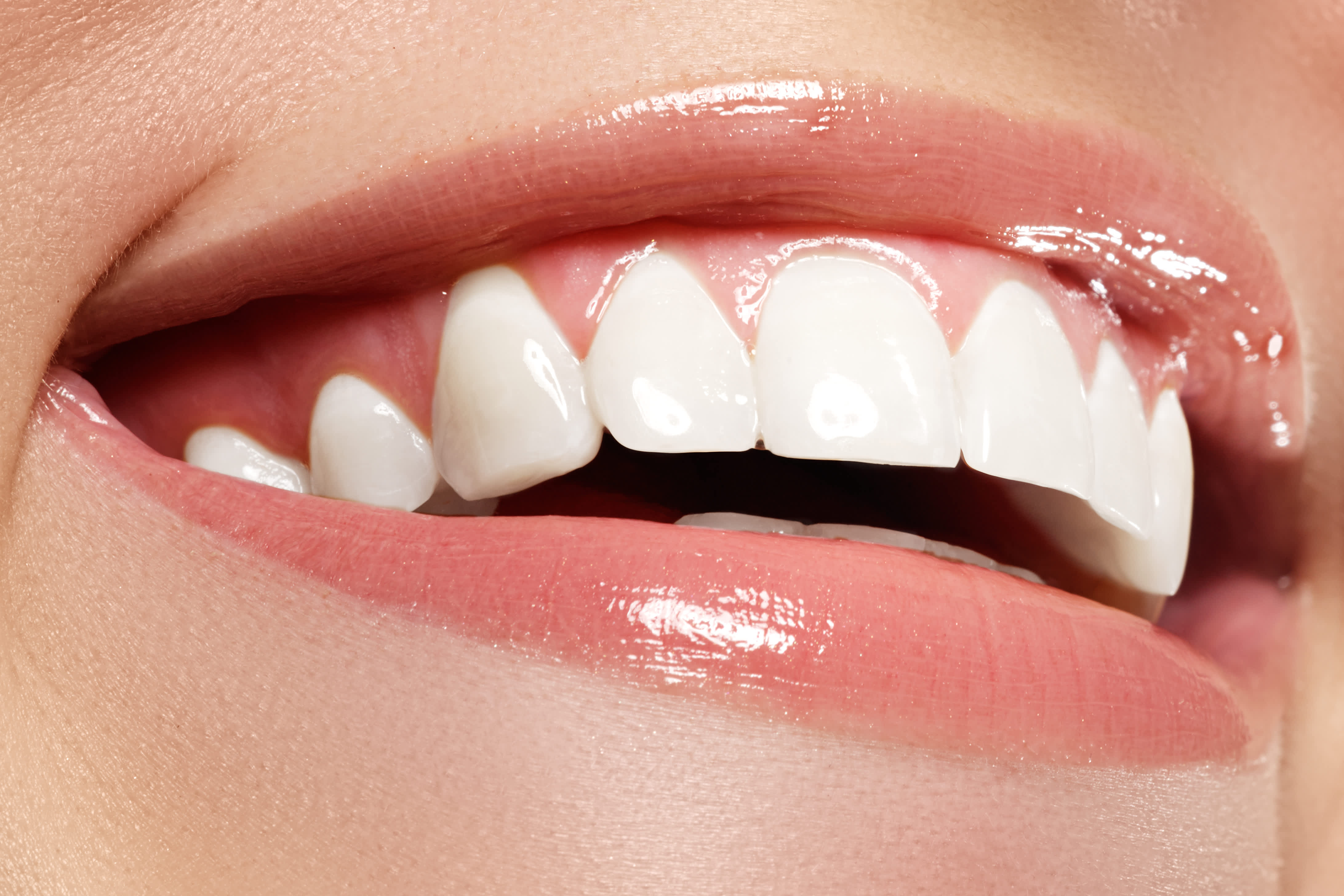 Стоматологическое отбеливание зубов. Отбеливание зубов. Красивые зубы. Отбеливание зубной эмали. Блеск зубов.