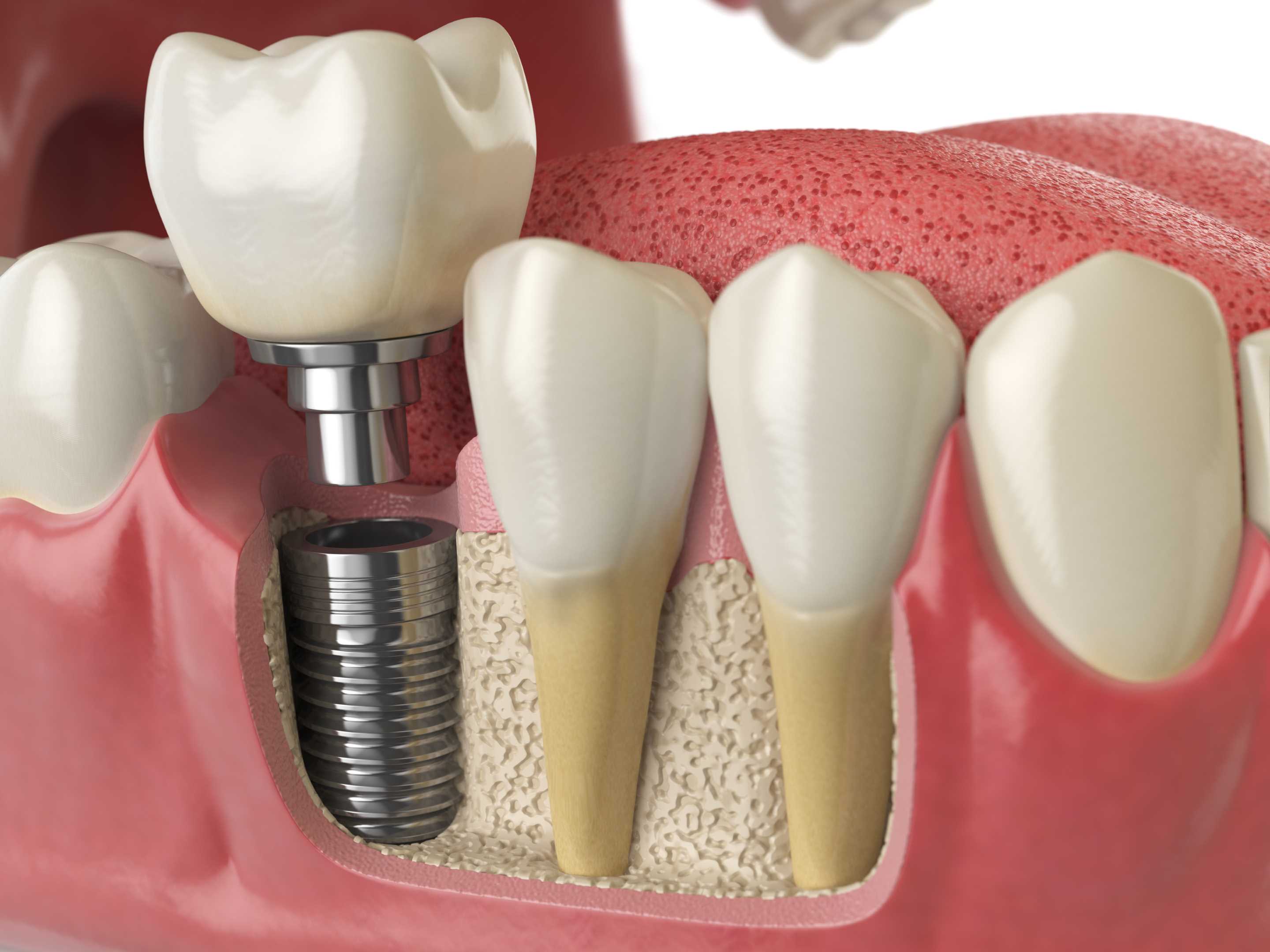 Dental Rotary Files Materials Medical Documents Sun Health Care Bengaluru Medical Supply Store