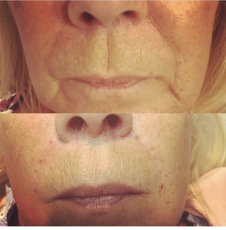 Dermal Fillers Fine Lines AntiAgeing Face Care Skin Grace