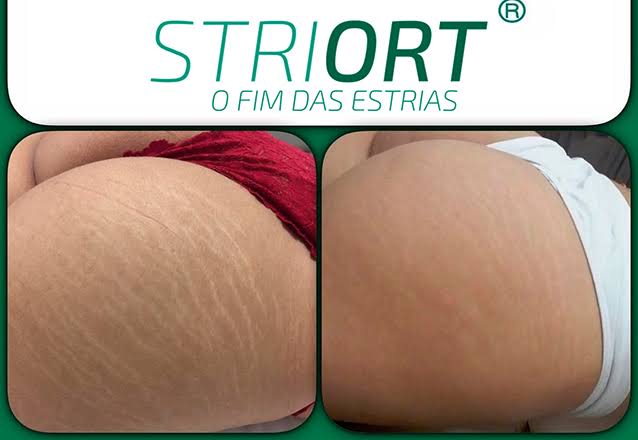 Tratamento de Striort