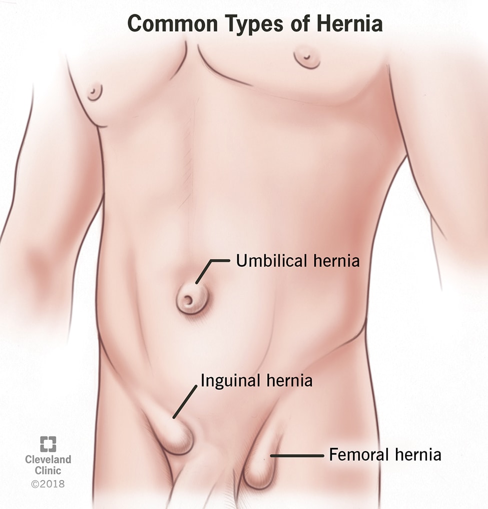 Infomedic - Una hernia umbilical puede no causar síntomas graves