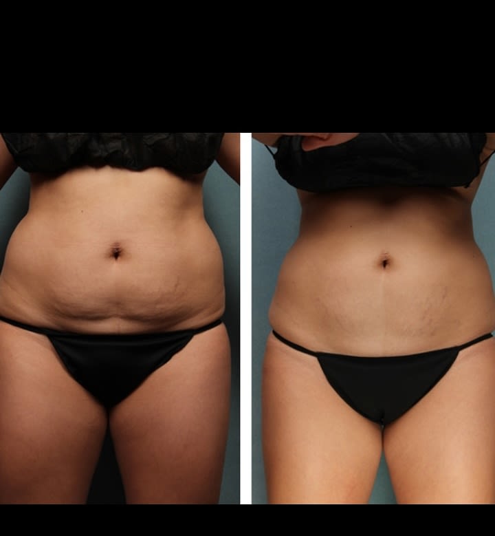 4 Ultrasonic Cavitation Sessions - Contouring Packages - Buy You By Simone  The Natural Way - Medical Spa | Brooklyn