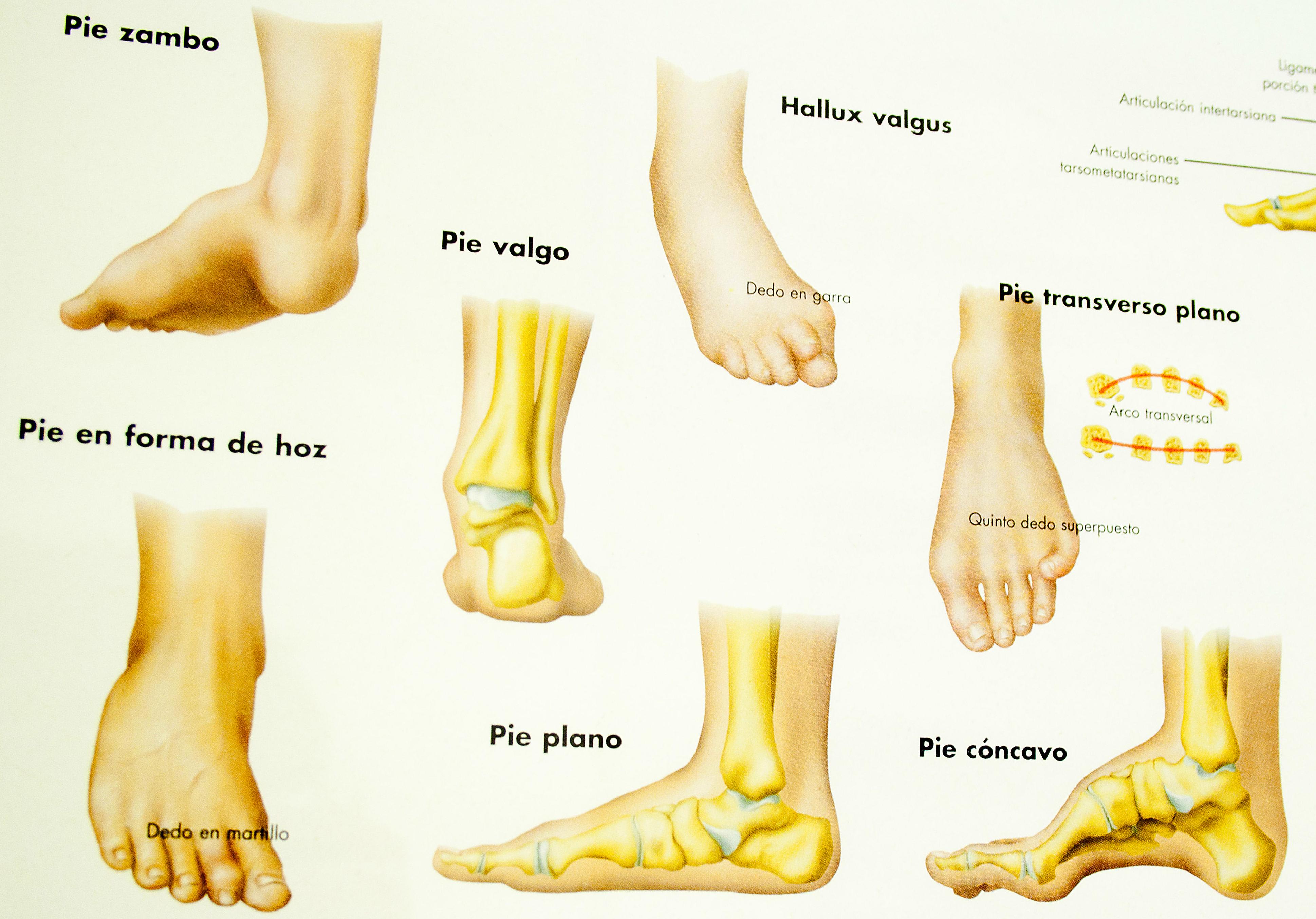 Fisioterapia podológica Podólogo Clínica de Podología Integral Pies Alegres CDMX