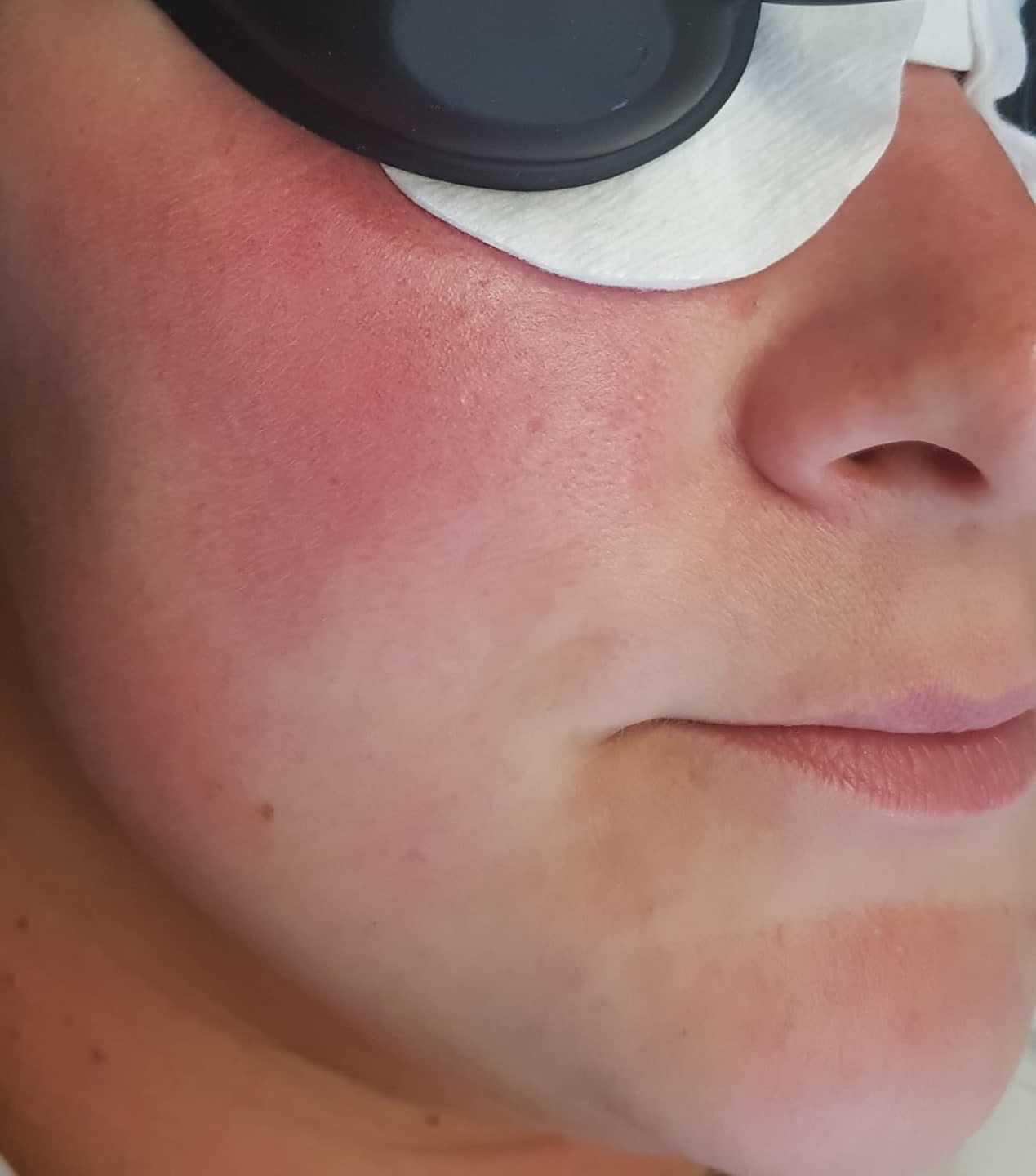 Electrolysis For Closing The Broken Capillaries Facials Beauty