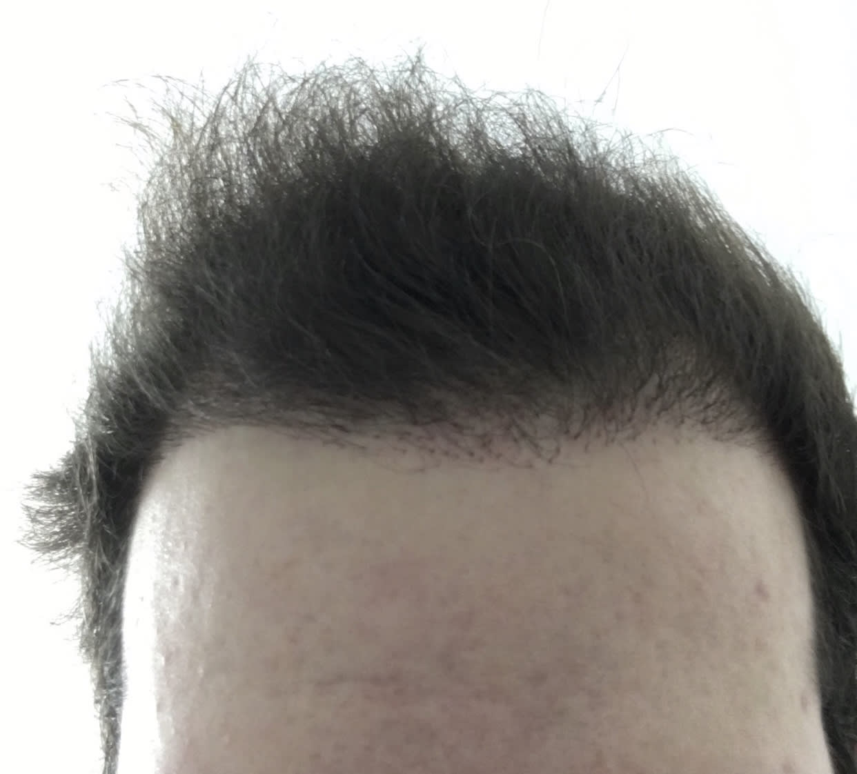 Regina Liposuction and Hair Transplant | Regina Regina Liposuction and Hair Transplant | Regina