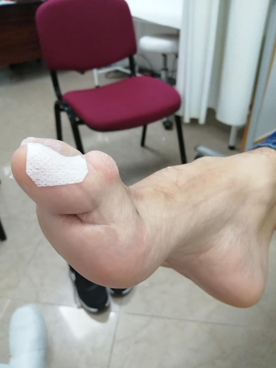 hallux-malleus-qu-es-podocuriosidades-cl-nica-del-pie-ayora