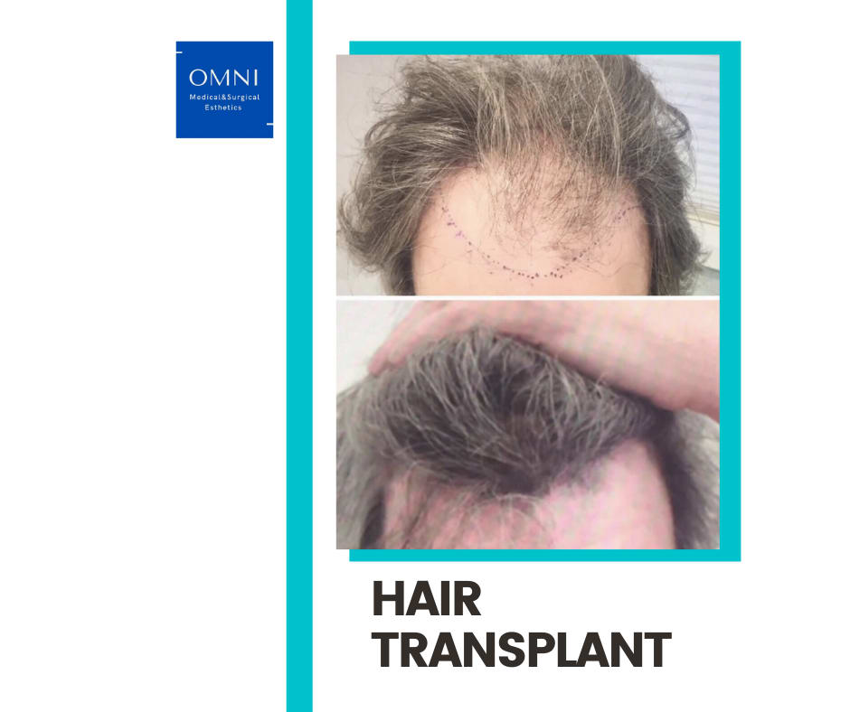 Regina Liposuction and Hair Transplant | Regina Regina Liposuction and Hair Transplant | Regina