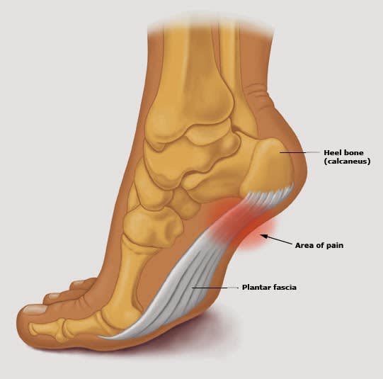 A REAL WORLD APPROACH TO HEALING PLANTAR FASCIOSIS ( PLANTAR FASCIITIS )  FOR RUNNERS & WALKERS