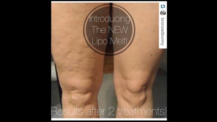 LipoMelt® Anti-Cellulite Treatment - My Options - NikkiBWellness ...