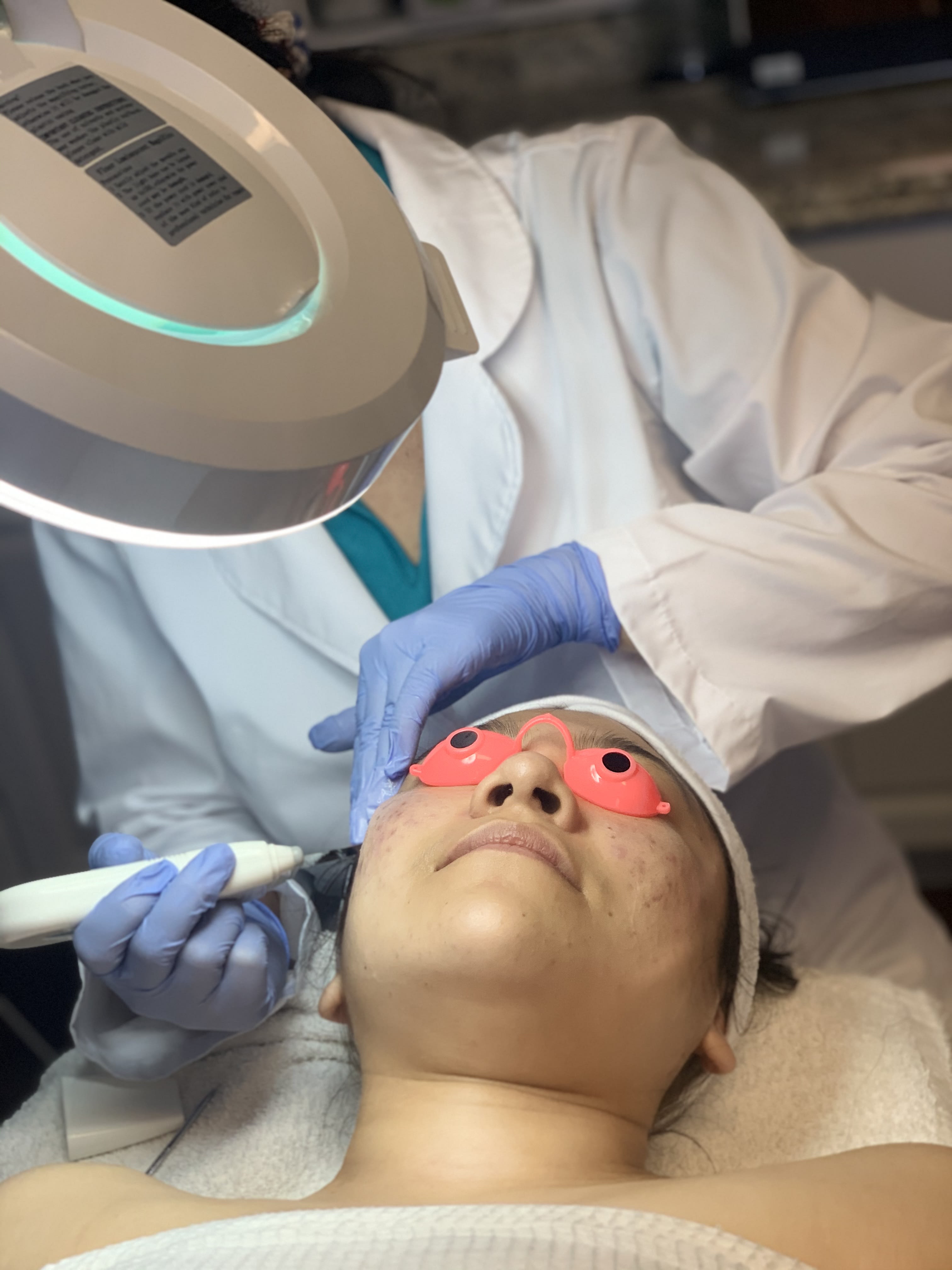 Acne Clearing Skin Care Specialist Island Esthetics in San Diego