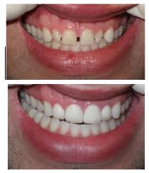 No Prep Composite Veneers - Smile Enhancements - The White Houz, LLC