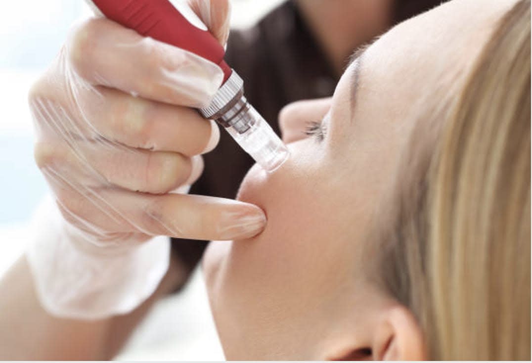 Microneedling w/ Hyaluronic Acid Microneedling Perfectly You Studio