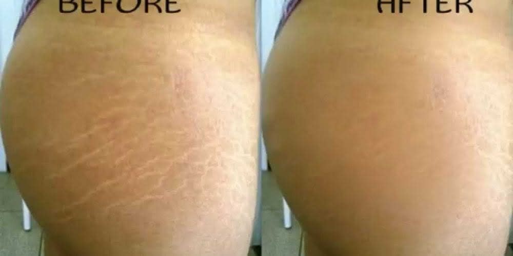 Stretch Marks Tattoo  Basic Info Risks Cost and Downsides