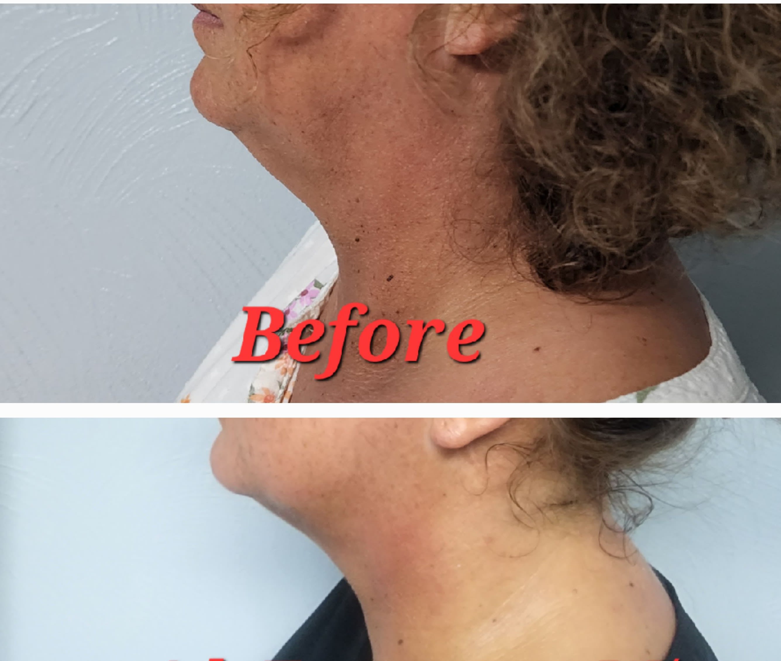 Chin & Neck Reduction - Body Sculpting - Simply Sculpted - Body