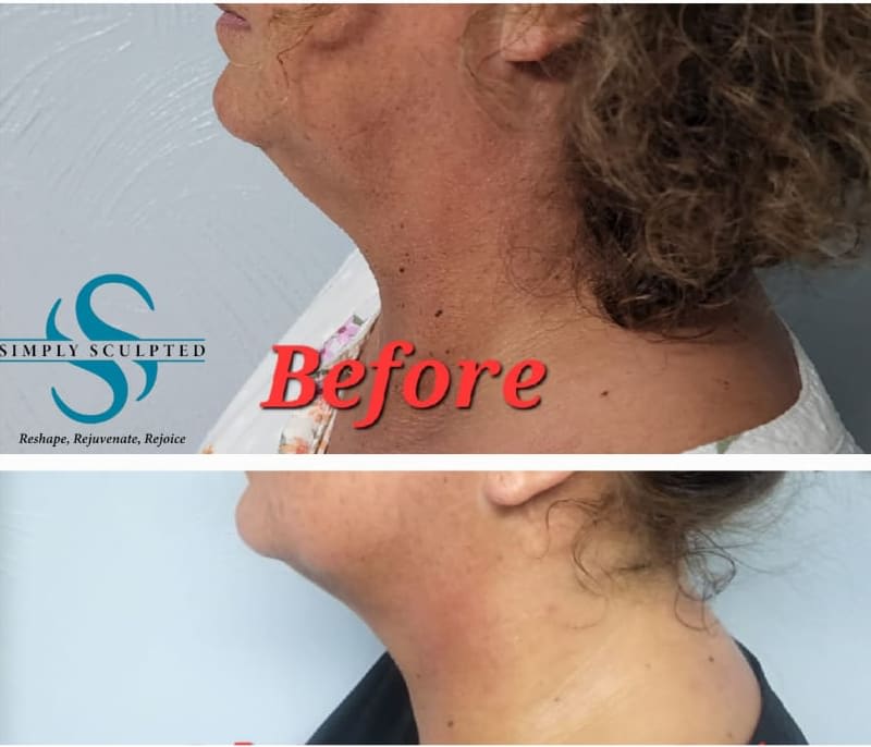 Chin & Neck Reduction - Body Sculpting - Simply Sculpted - Body Sculpting