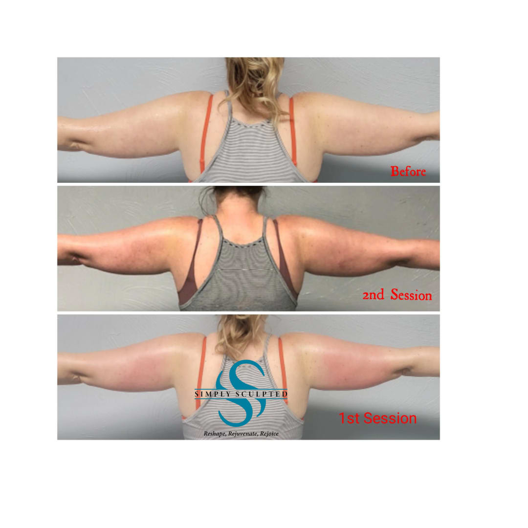 Chin & Neck Reduction - Body Sculpting - Simply Sculpted - Body