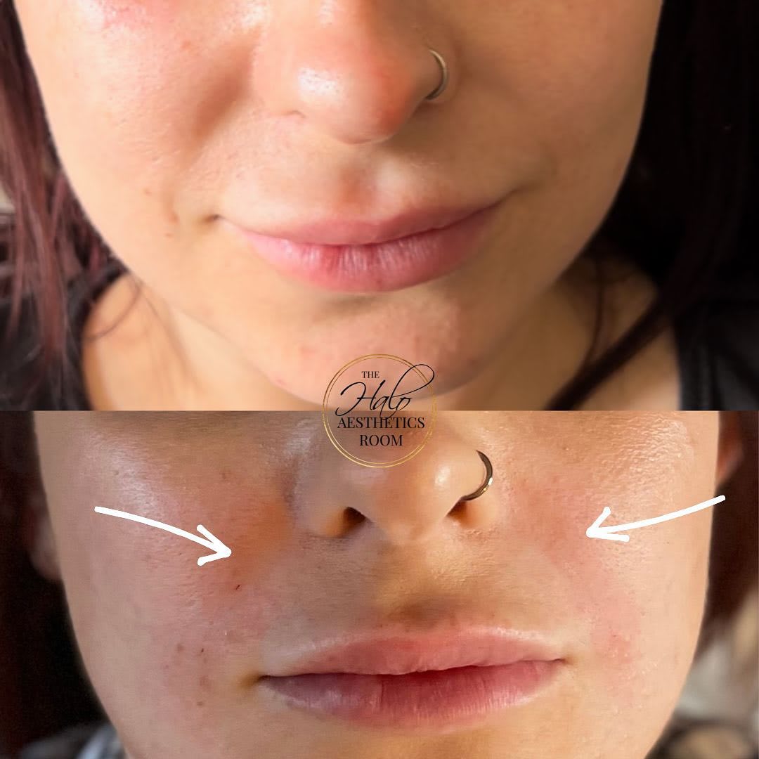 Nose to Mouth Lines (Nasolabial Folds) Dermal Fillers The Halo