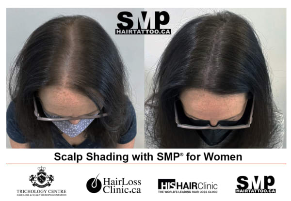 SMP Before & After Photo Gallery. Hair Tattoo Clinic Leicester UK