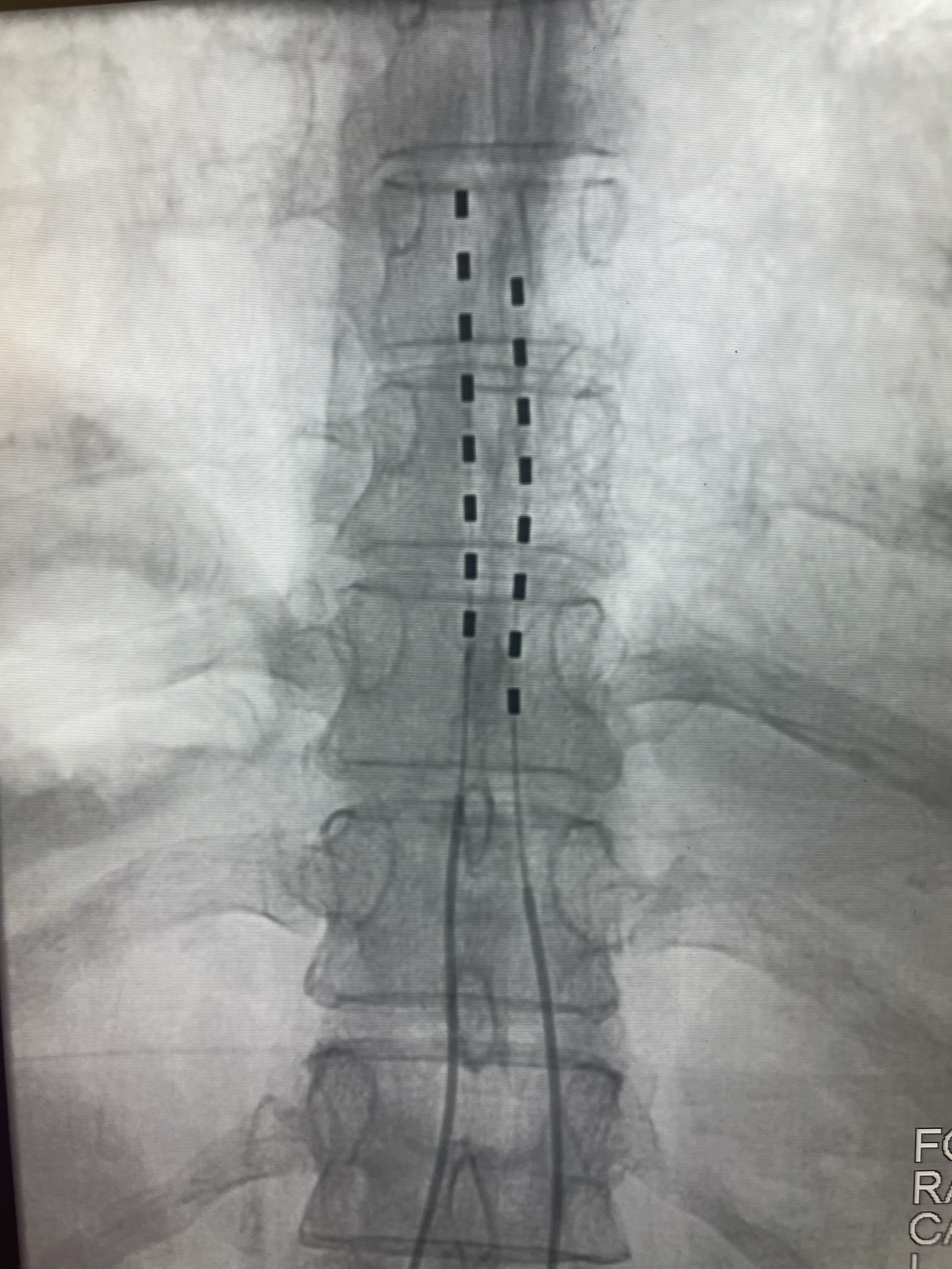 SPINAL STIMULATORS, SPACERS, FUSIONS & KYPHOPLASTY Our Services