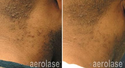 PFB Aerolase Laser Treatments Veautiful Aesthetics Medical Spa Stamford