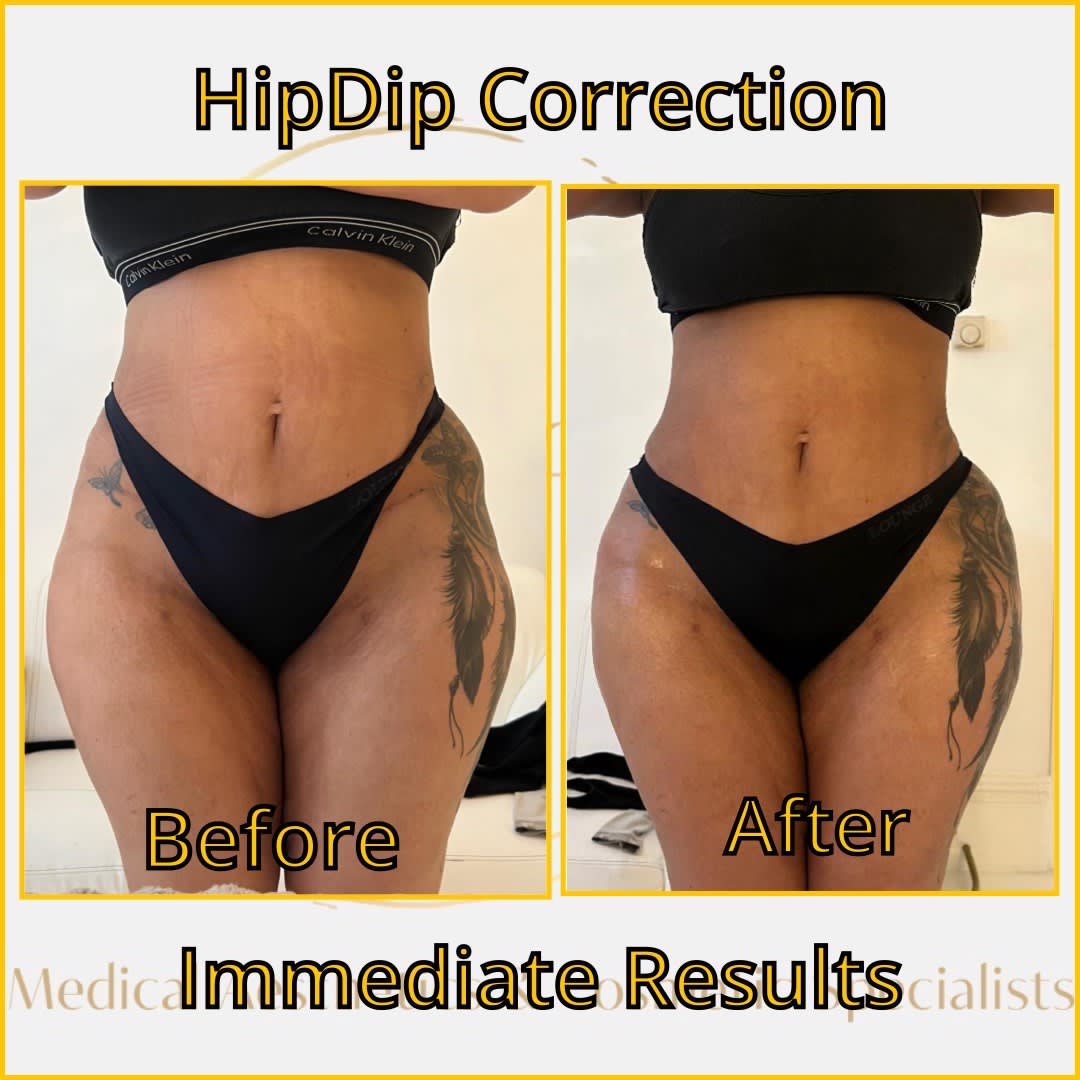Hip Augmentation Hip Dip Non Surgical Bbl Buttocks Augmentation