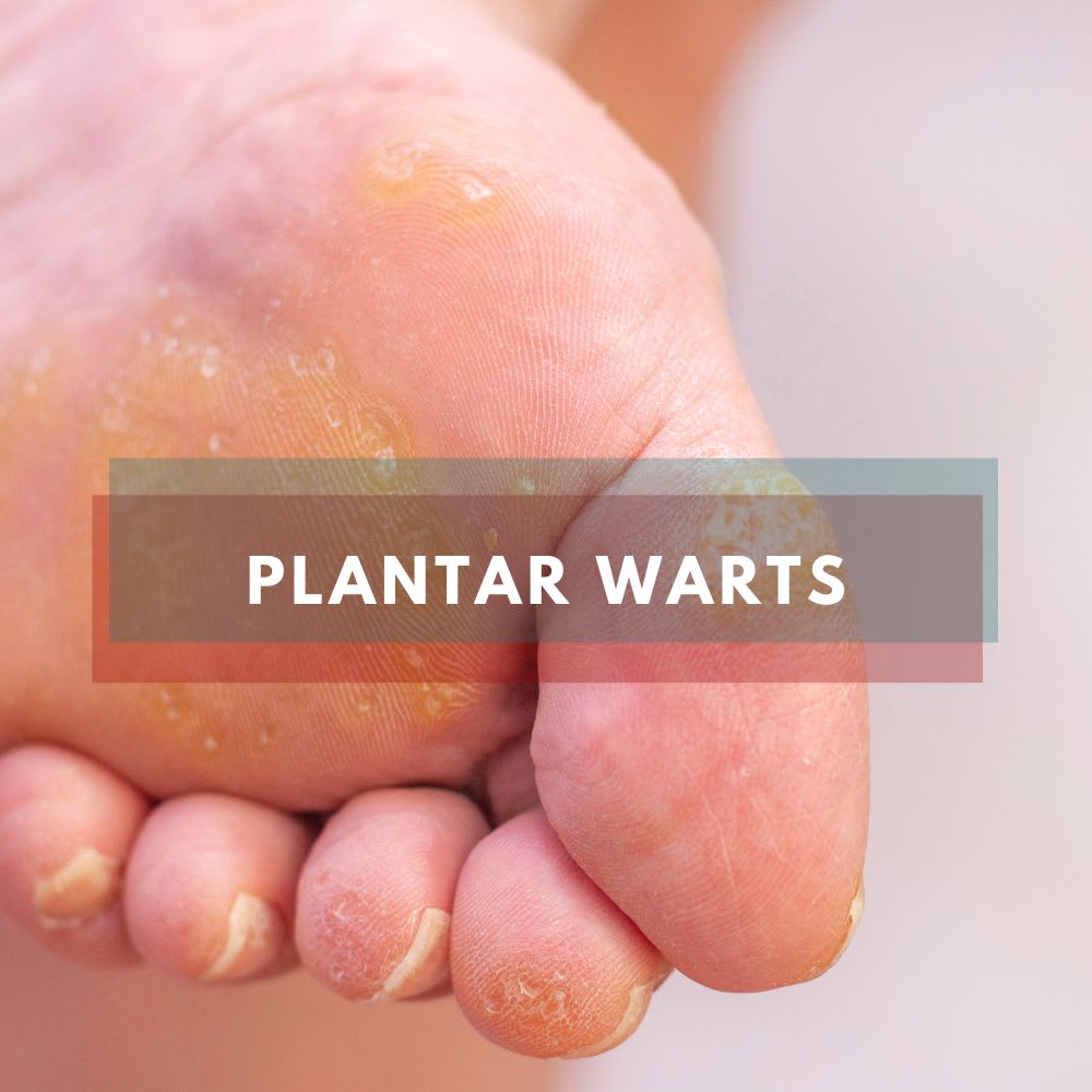 Plantar Wart Care - Specialties - Hampden Podiatry Associates ...