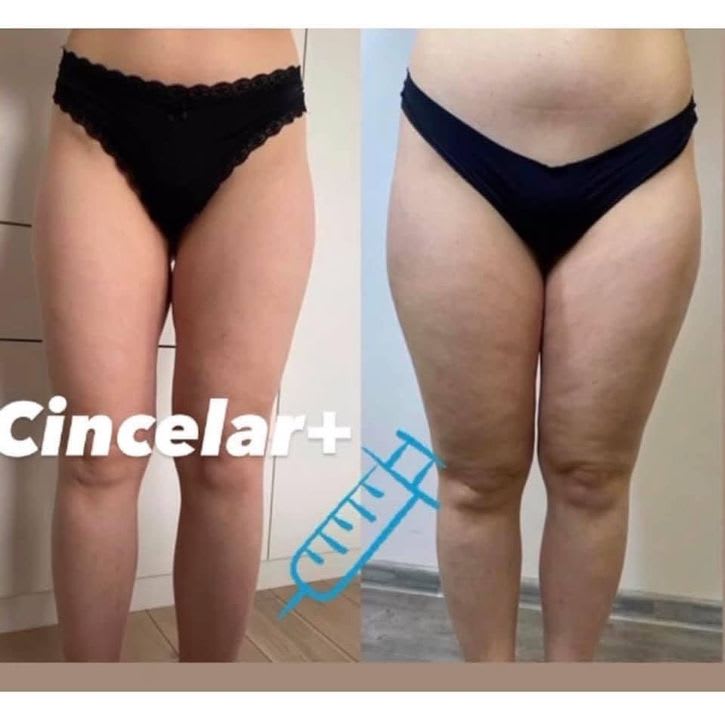 lemon bottle fat dissolving thighs Lemon Bottle fat dissolving treatment - Services - Willow Aesthetics  Cumbria | Medical Beauty Salon