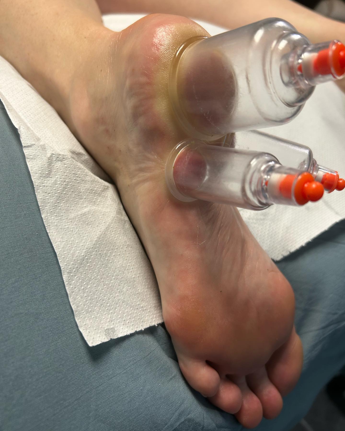 Ultrasound Therapy Treatment Physiotherapy Rehabilitation