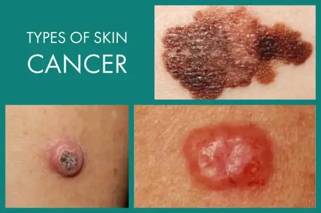 Types of Skin Cancers - Clarifying Cancer a Diverse Group of Diseases ...