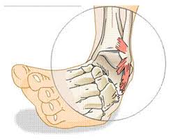 Effective Ankle Sprain Exercises for a Speedy Recovery