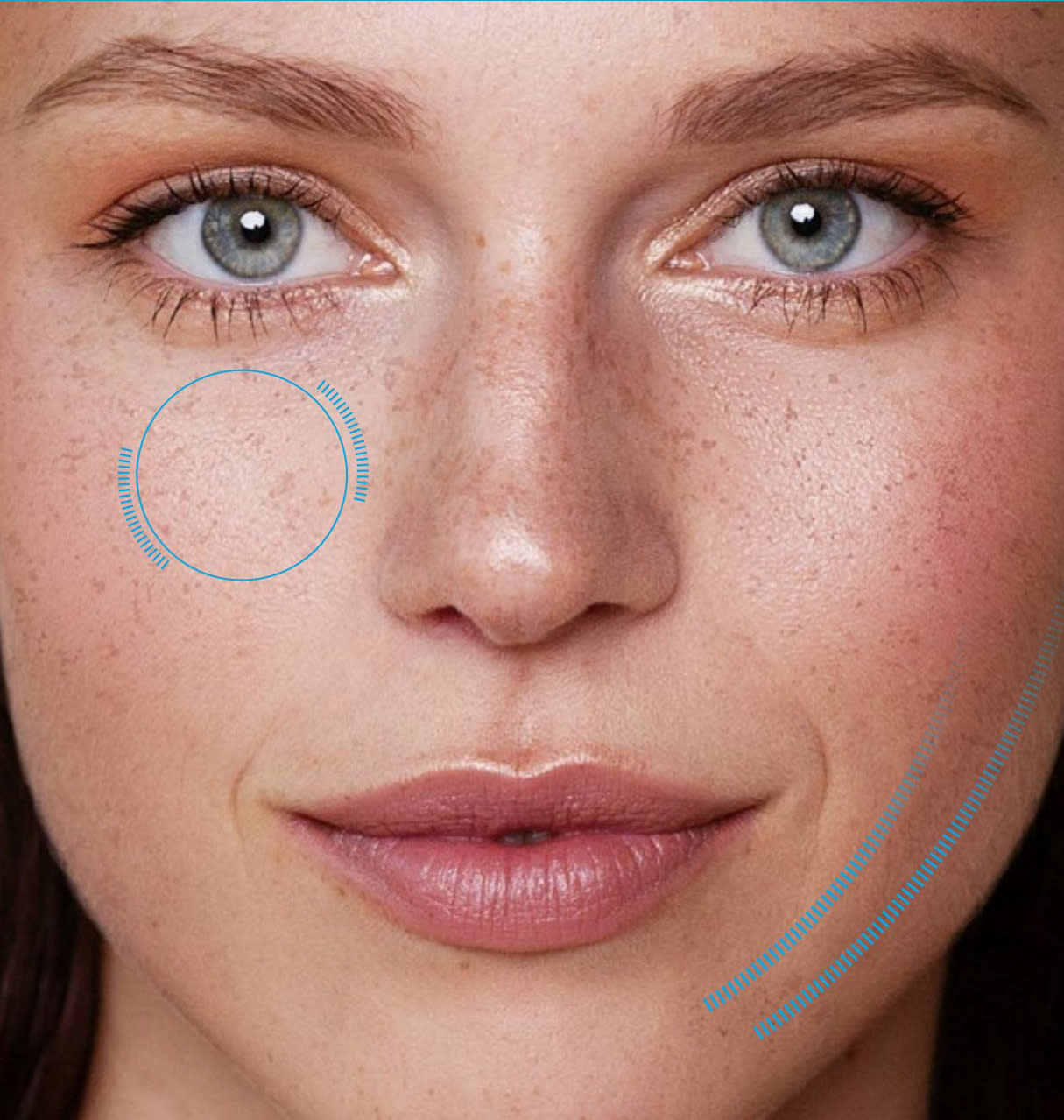 Endolift (non-surgical facelift)