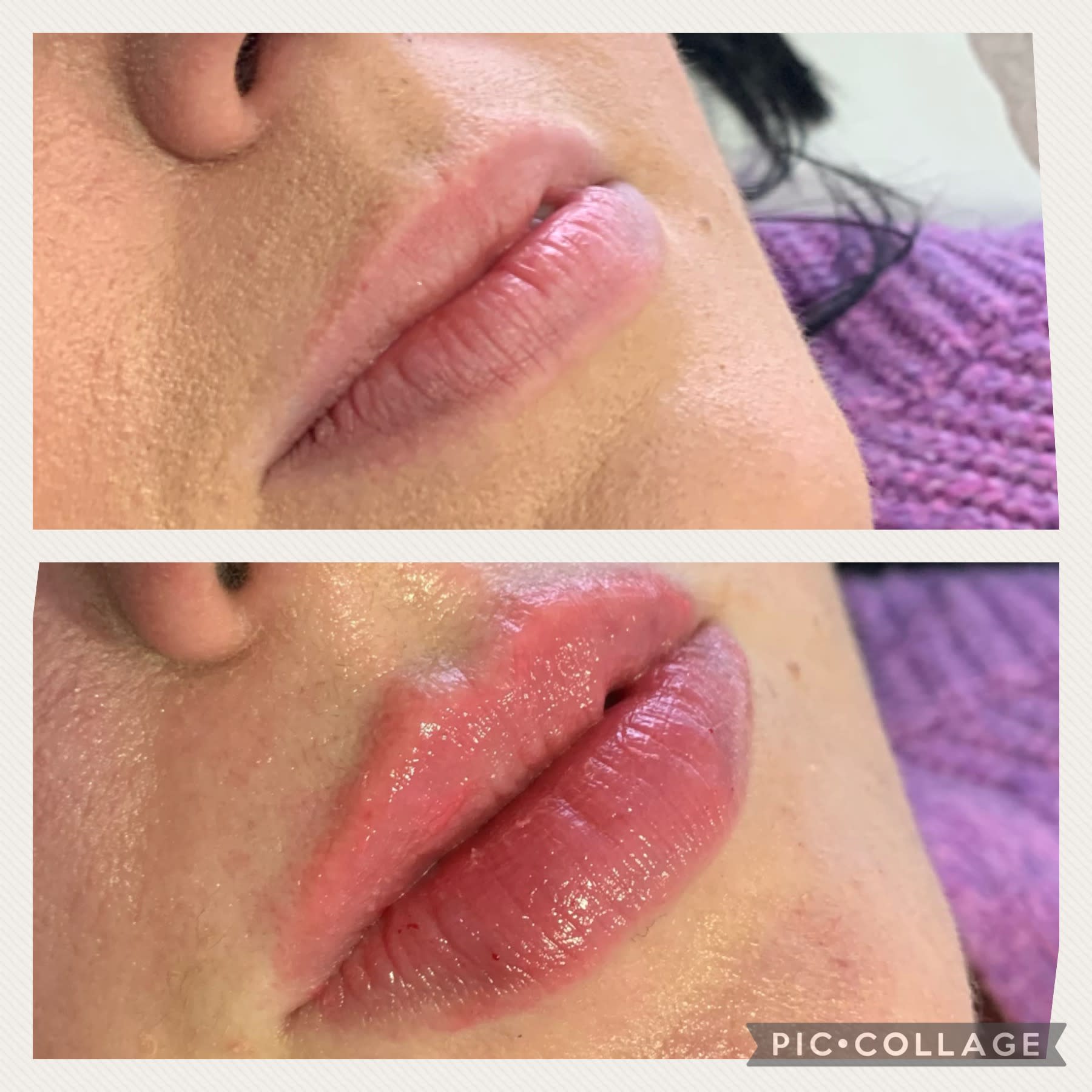 Lip Filler - High End Treatments - Bella Goode Hair, Beauty & Training  Academy | Hereford