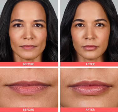 botox injectons for lips n.c Dermal Fillers - Aesthetics Services - Charlotte Aesthetics Glutathione soap