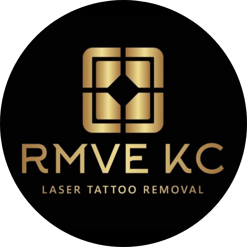 RMVE KC Laser Tattoo Removal