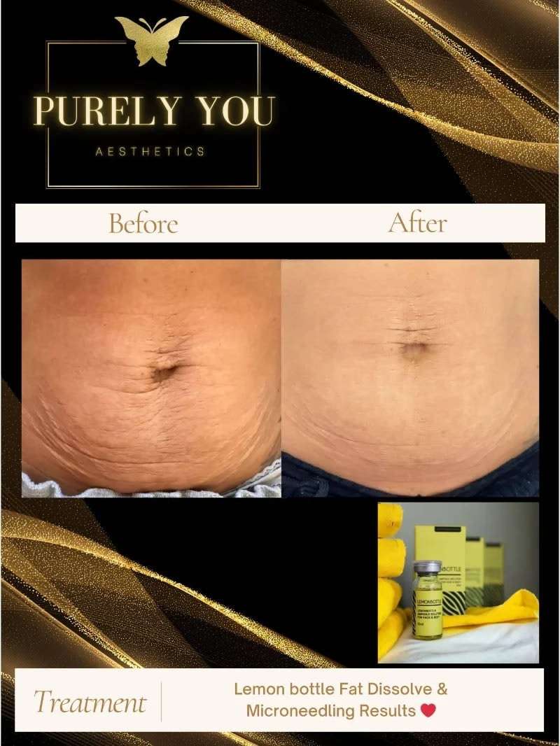 Fat Dissolving Lemon Bottle - Packages - Purely You Aesthetics | Anti-Wrinkle & IV Drip Therapy in Bromley Fat Dissolving Lemon Bottle - Packages - Purely You Aesthetics | Anti-Wrinkle & IV Drip Therapy in Bromley