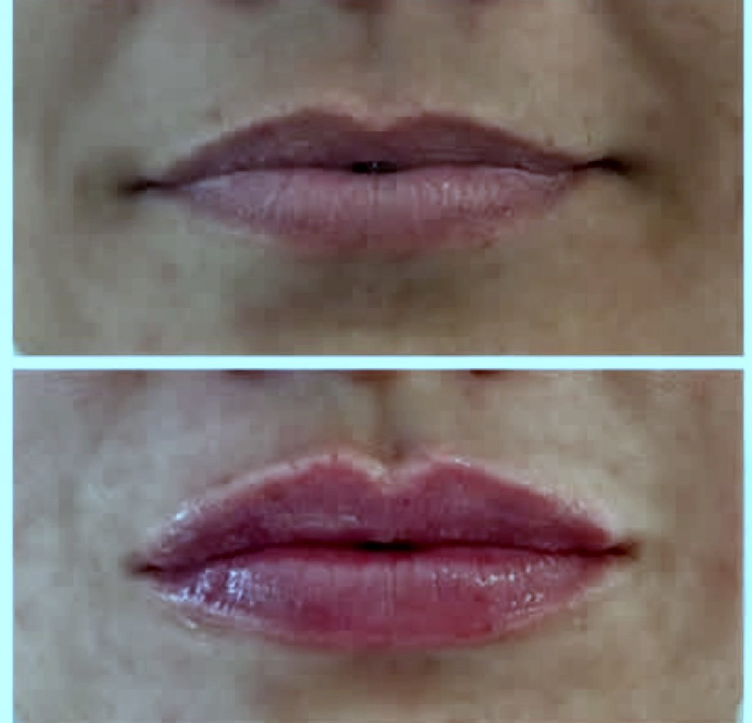 semaglutide and lip filler Enhancement Lip Filler Recovery & Swelling