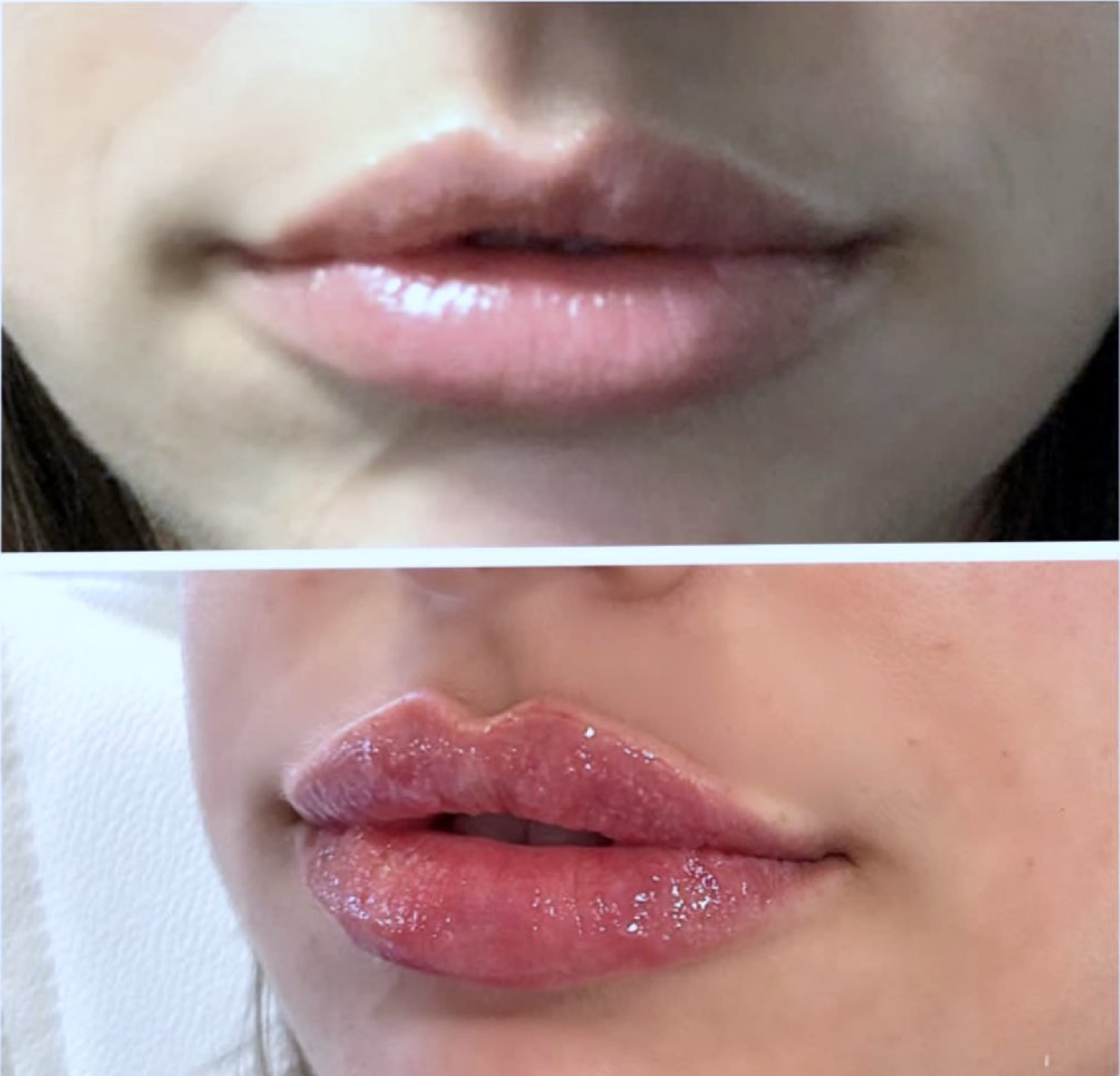 semaglutide and lip filler Plump Up Your Pout! Transform your lips with our magic! Check out these stunning before after results that speak for themselves! Our current promotion offers What is Semaglutide Face? |