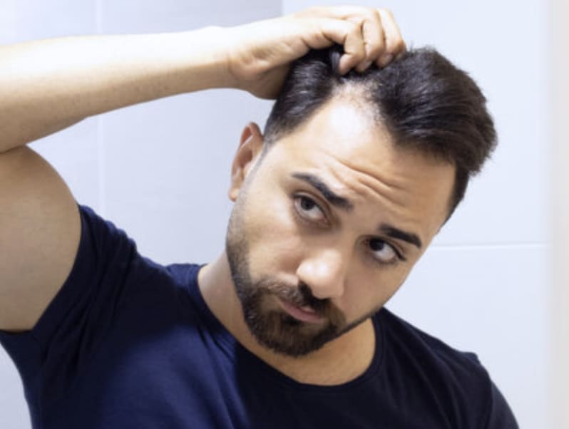 Stress-Related Hair Loss vs. Genetic Hair Loss: How to Tell the Difference