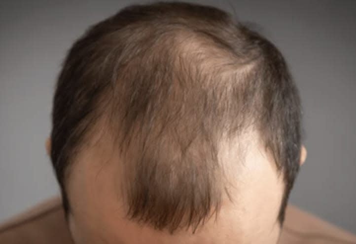 Common Lab Abnormalities Linked to Hair Loss